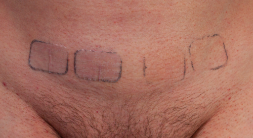 Adriana Knouf, wearing her Vivelle Dot estradiol patches (2020); credit, Adriana Knouf